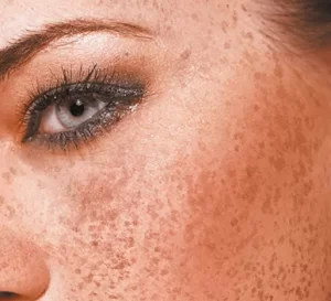 melasma