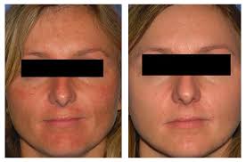 melasma skin